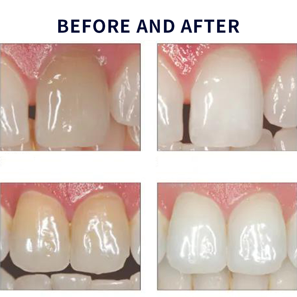 Opalescência Whitening Gel Kit - Teeth Whitening With Peroxide avaliação e preço
