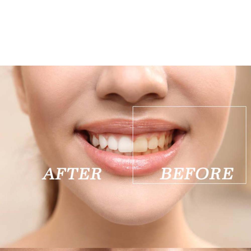 Kit de gel para clareamento de - Teeth Whitening With Peroxide avaliação e preço